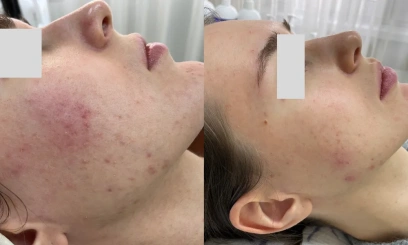 Уход-чистка  Голливудская чистка ZO Skin health от Zein Obagi Уход-чистка  Голливудская чистка ZO Skin health от Zein Obagi